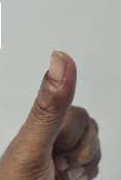  before treatment