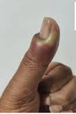  after treatment