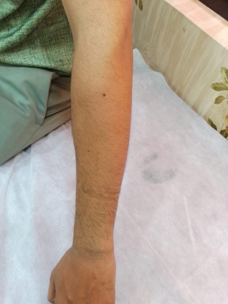  before treatment