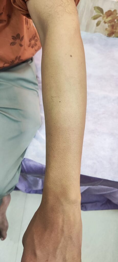  after treatment