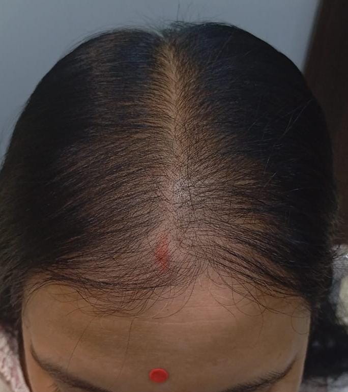  after treatment