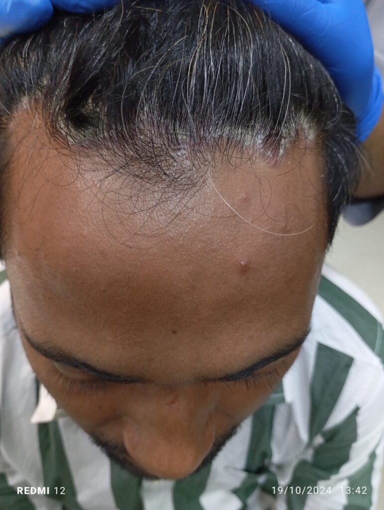  before treatment