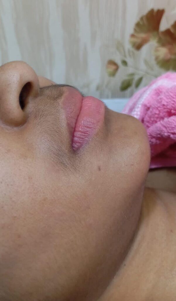  before treatment