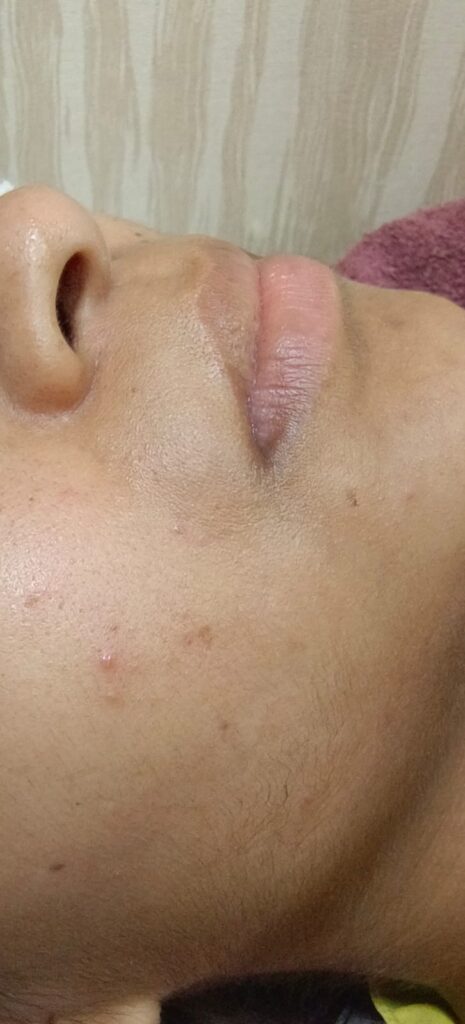  after treatment