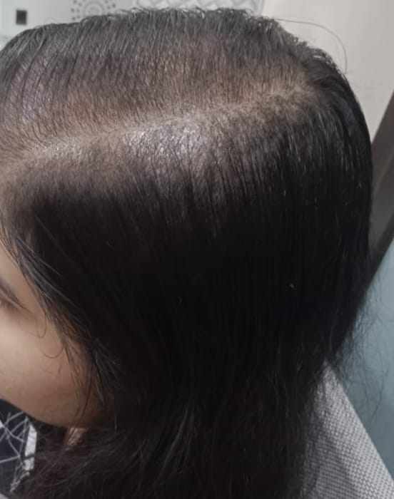 after treatment