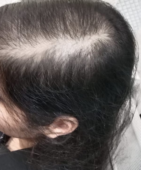  before treatment